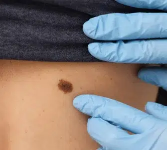 Cómo revisar lunares y manchas en la piel