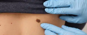 Cómo revisar lunares y manchas en la piel