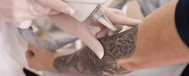 Eliminacion de tatuajes con láser