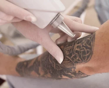 Eliminacion de tatuajes con láser