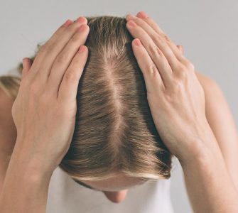 perdida cabello mujer