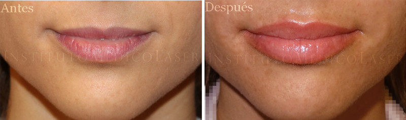Relleno de labios antes y después