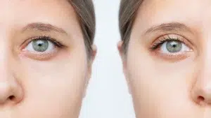 blefaroplastia antes y despues