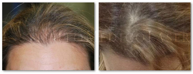 Antes y después del tratamiento de alopecia difusa con microinjerto FUE en mujer