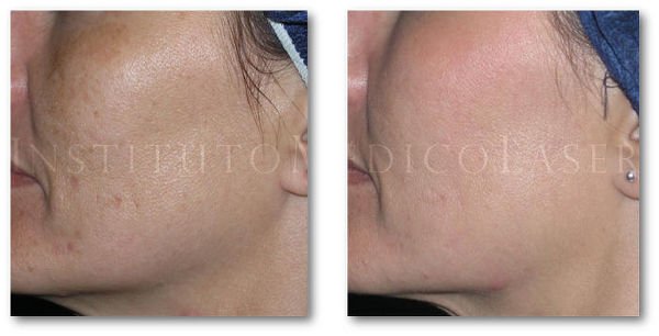 Antes y después de eliminar el melasma facial