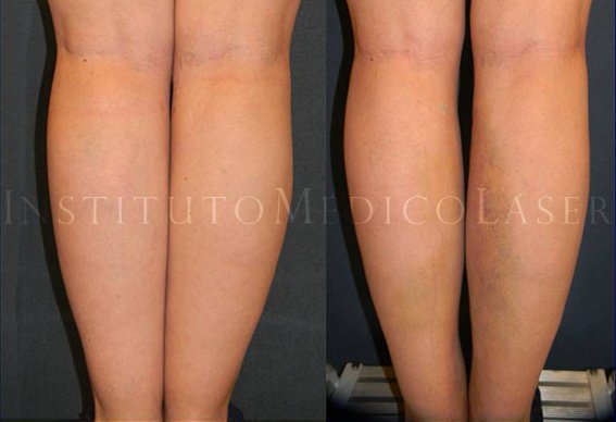 Antes y después de la remodelación de rodillas, gemelos y tobillos con Lipoláser