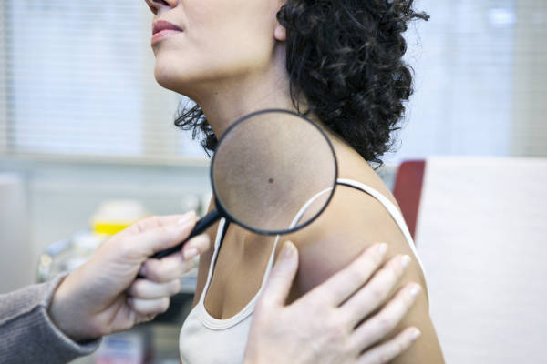Controlar las manchas en la piel y los lunares permiten el diagnóstico precoz del melanoma