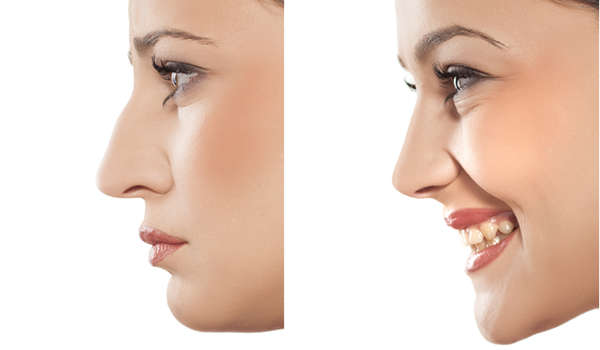 Al corregir el dorso nasal, aumenta la percepción global de belleza en el rostro