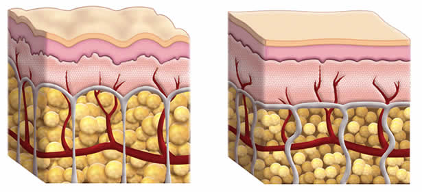 Las cuatro fases de la celulitis son: edema intersticial, exudativa, fibrosis y esclerosis 