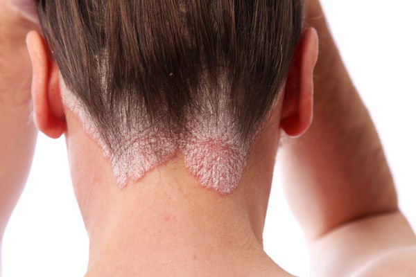 La dermatitis seborreica cursa con escamas blanquecinas