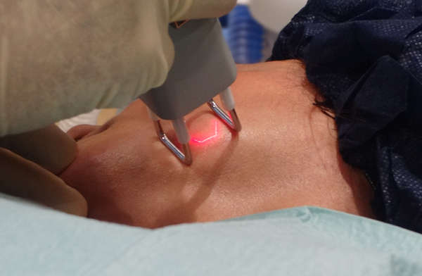 El láser en Dermatología se aplica tanto para corregir lesiones estéticas como lesiones clínicas 