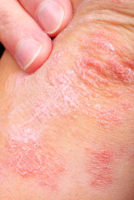 Las dermatosis fotoalérgicas cursan con reacciones en forma de eczema