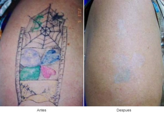 Eliminación de Tatuajes