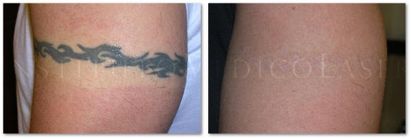 Eliminar tatuaje con láser, antes y después