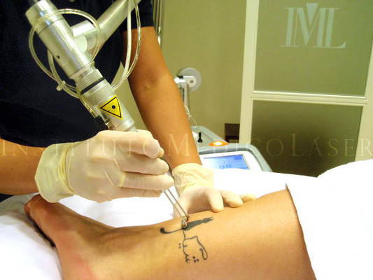 Eliminación de tatuaje con láser Q-Switched en IML