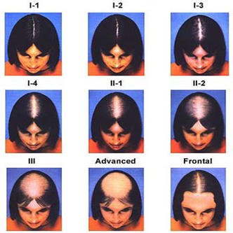 Grados de alopecia androgenética femenina