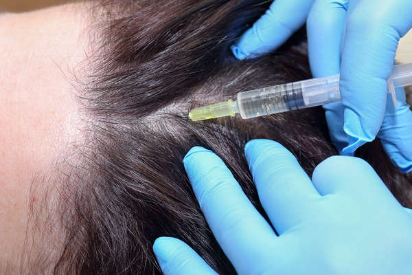El injerto de células madre y la mesoterapia capilar se aplican mediante microinyecciones en el cuero cabelludo