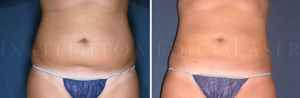 Antes y después de Lipoláser o liposucción láser en abdomen