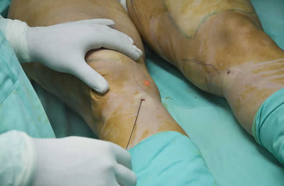Los acúmulos de exceso de tejido graso en piernas se corrigen con facilidad gracias a la lipoescultura