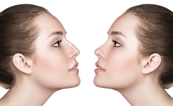 mejorar nariz sin cirugia