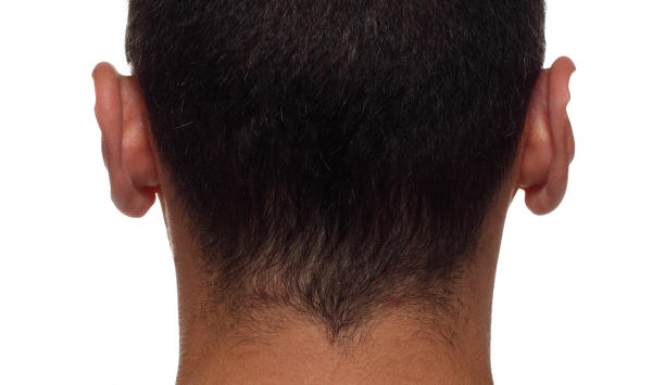 Mediante la técnica FUT se extrae una tira de cuero cabelludo de la parte posterior de la cabeza