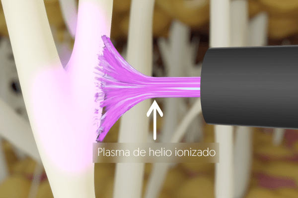 Plasma de helio ionizado de IML (Madrid)