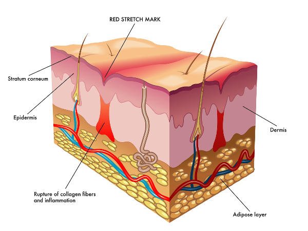 Las estrías son marcas en la piel fruto de la ruptura de las fibras de la dermis