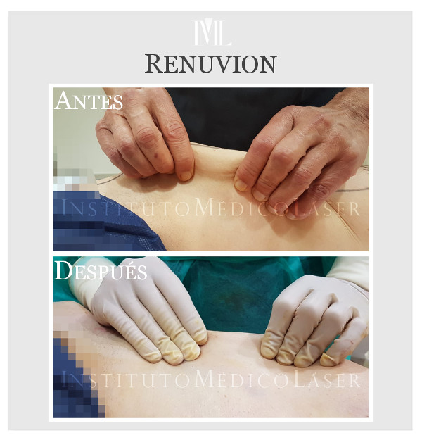 Renuvion antes y después en IML (Madrid)