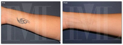 Tatuaje antes y después del tratamiento con láser