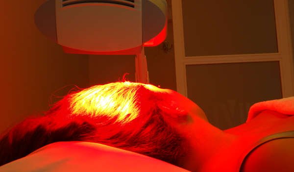 Estimulación con luz roja de baja frecuencia contra la alopecia