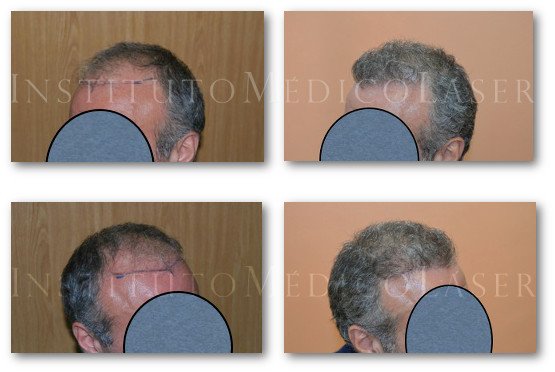 Trasplante capilar antes y después