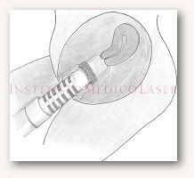 Tratamiento láser para recuperar el tono vaginal en IML