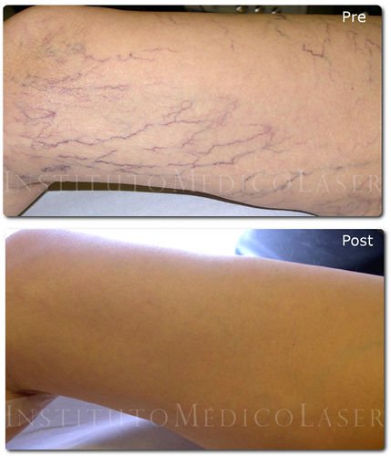 Imagen de varices antes y después del tratamiento con TFD