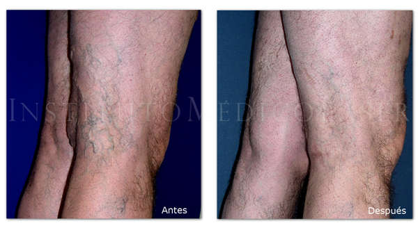 Varices en piernas de varón, antes y después