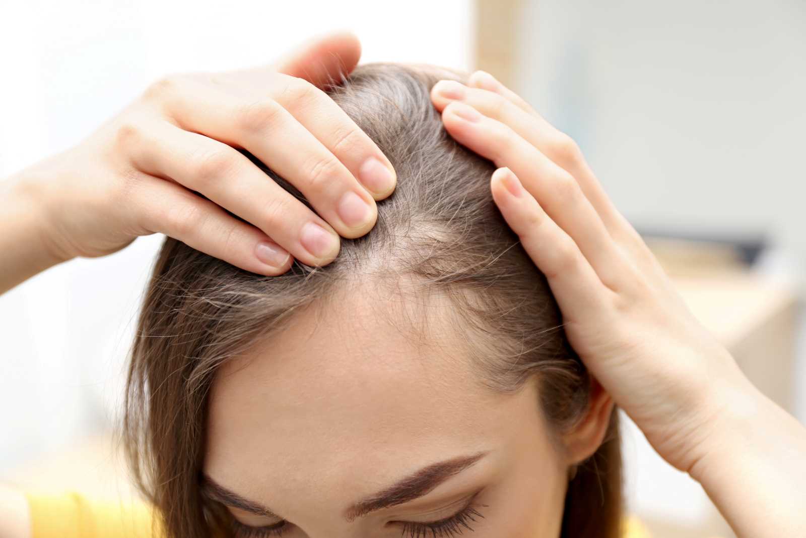 la seguridad distorsión Acostumbrarse a Causas de la alopecia en mujeres | IML