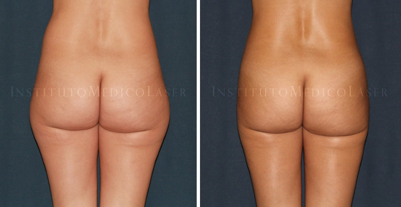 Antes y después de Lipohelio en caderas