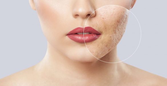 mujer con acne en cara