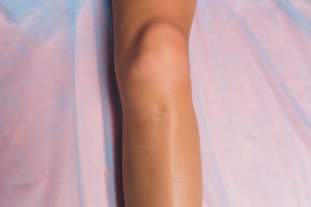 pierna con cicatriz en rodilla