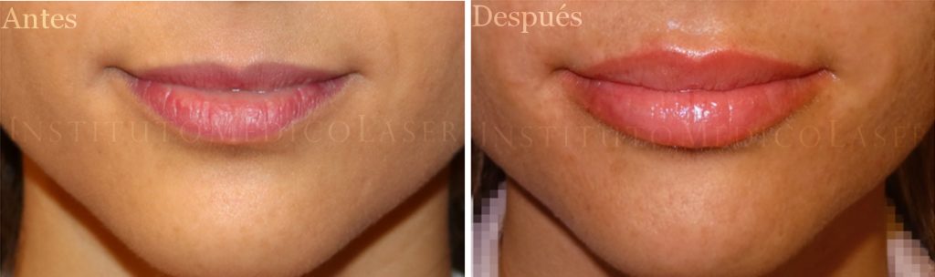 Russian Lips antes y después