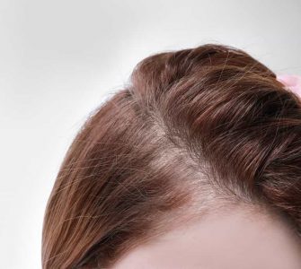 que es alopecia difusa