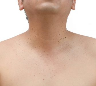 persona con queratosis seborreica