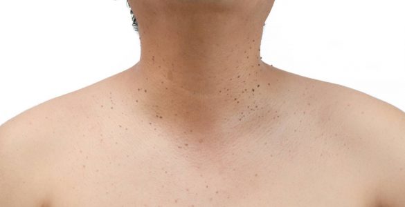 persona con queratosis seborreica