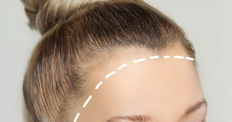 La línea frontal es una de las zonas donde puede localizarse el liquen plano pilar