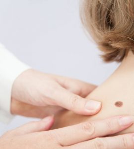 nevus espalda mujer
