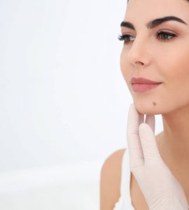 mujer con nevus en cara