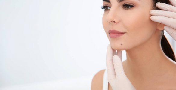 mujer con nevus en cara