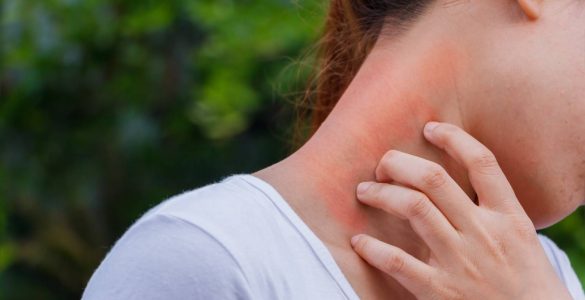 mujer rascando cuello