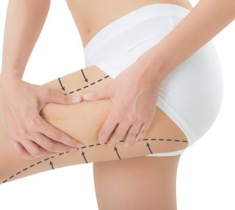 celulitis muslo mujer