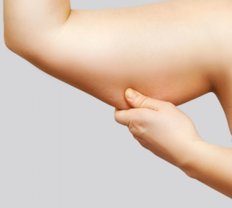 Flacidez a los 40: qué es y cómo puedo tratarla