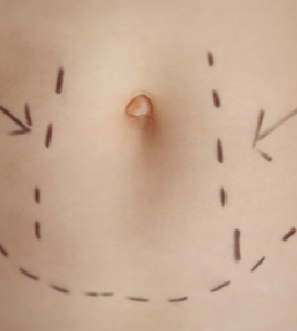 vaser lipo